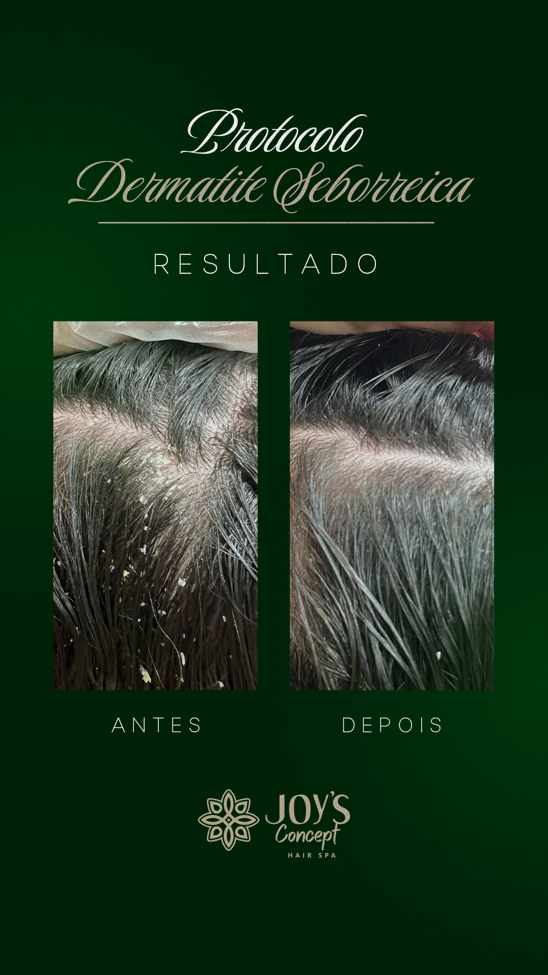 0402---Antes-X-Depois-11-Dermatite-seborreica