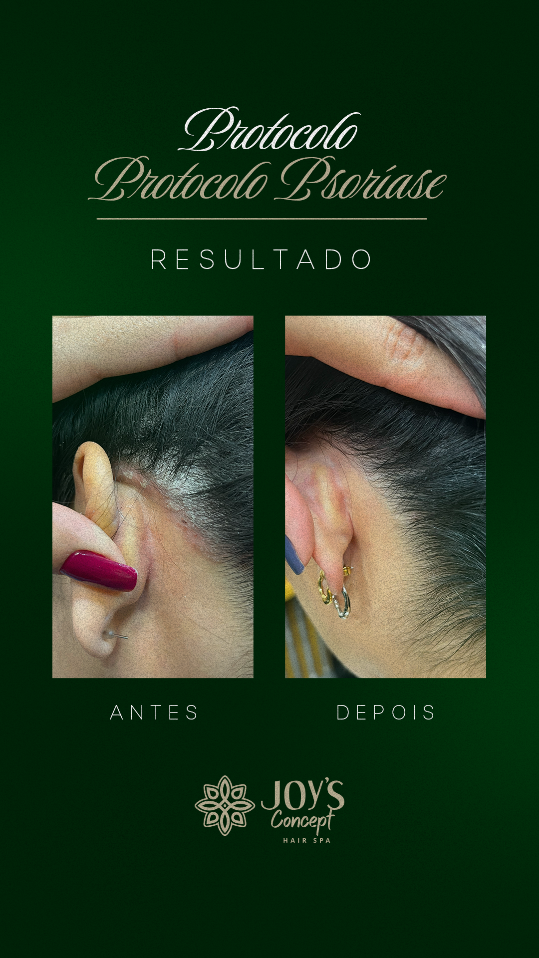 0402---Antes-X-Depois-12-Protocolo-Psor_C3_ADase