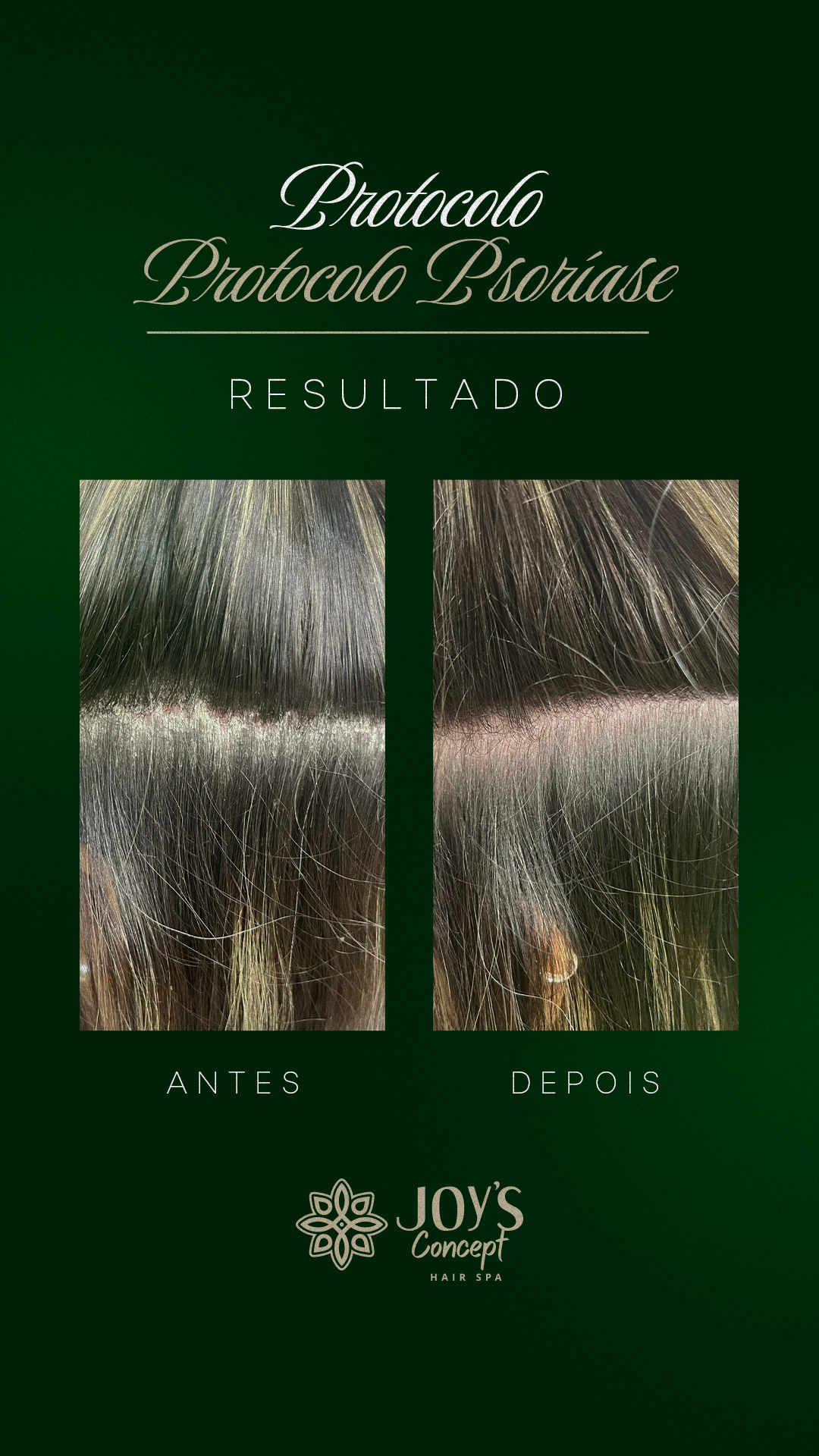 0402---Antes-X-Depois-13-Protocolo-Psor_C3_ADase