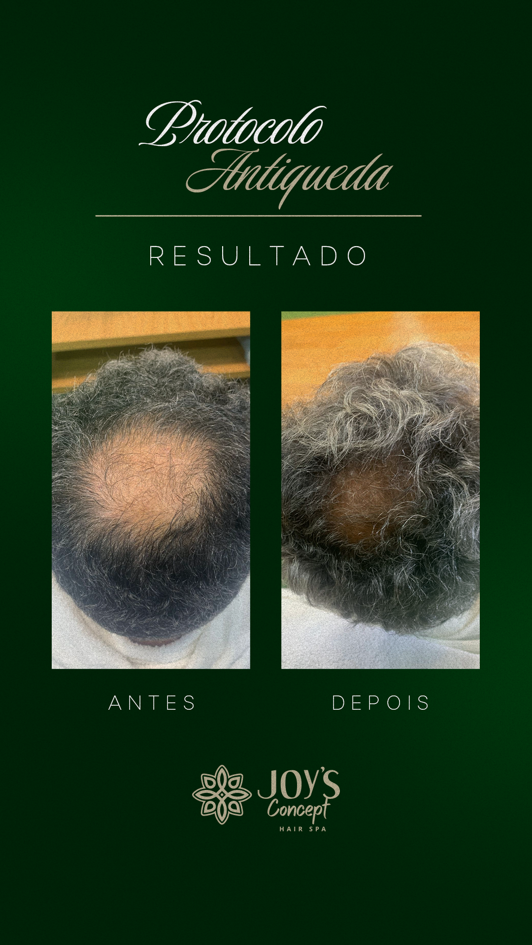 0402---Antes-X-Depois-4-Antiqueda