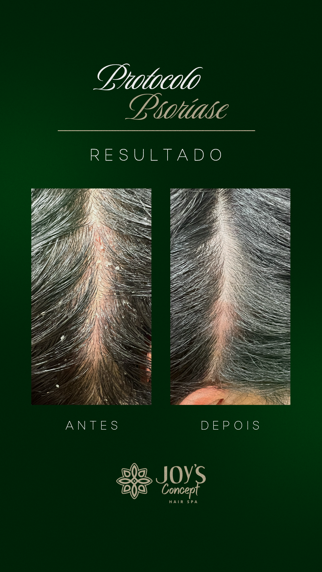 0402---Antes-X-Depois-9-Protocolo-Psor_C3_ADase