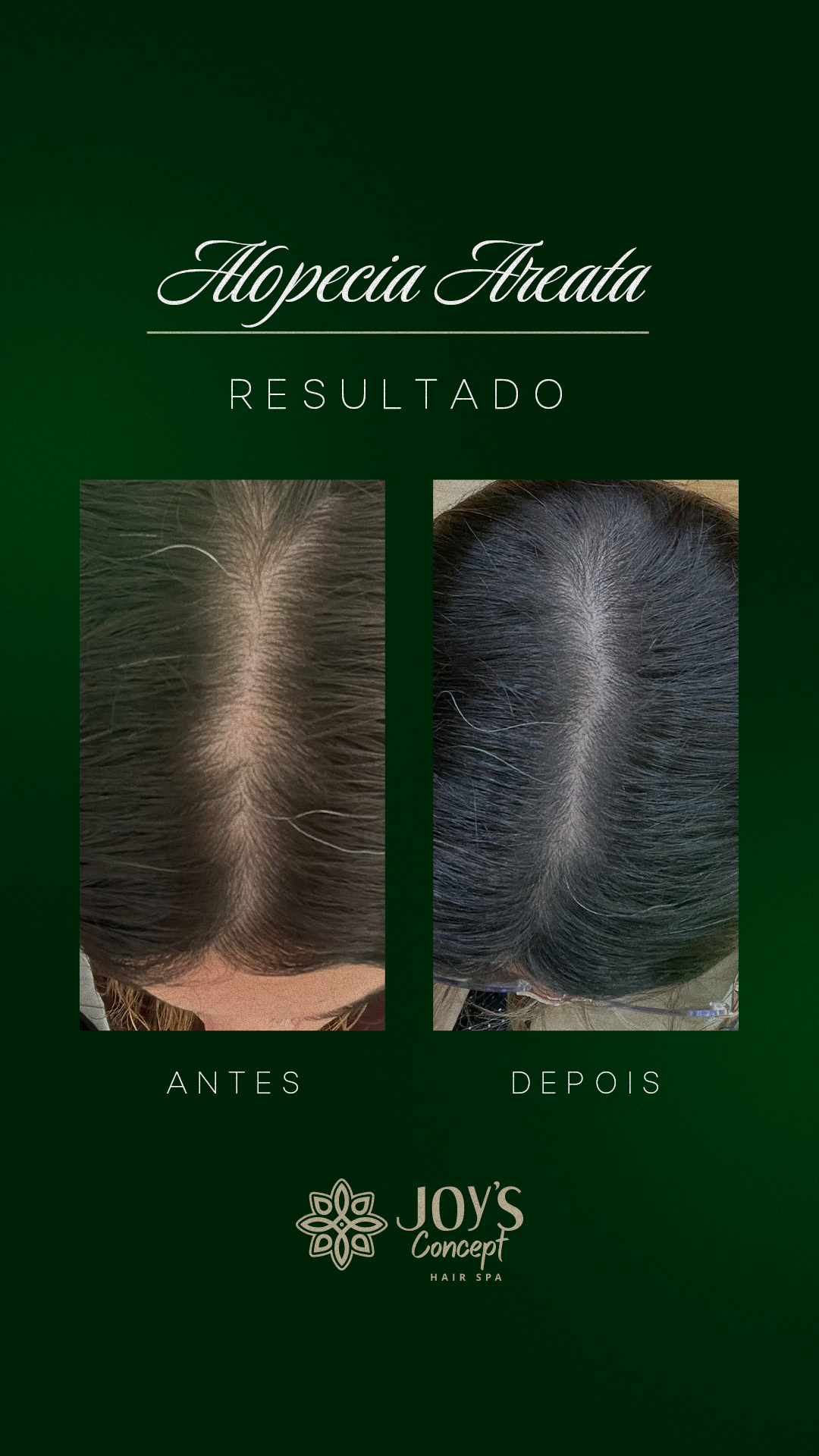 0402---Antes-X-Depois14---Alopecia-Areata-