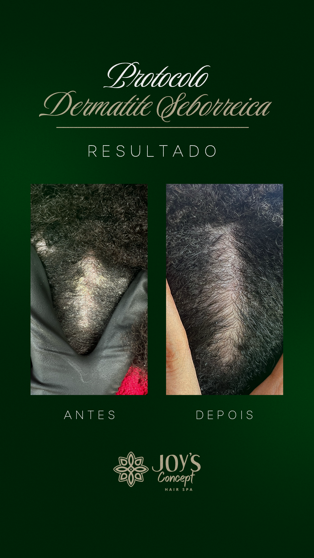 0402---Antes-X-Depois15.1---Dermatite-Seborreica