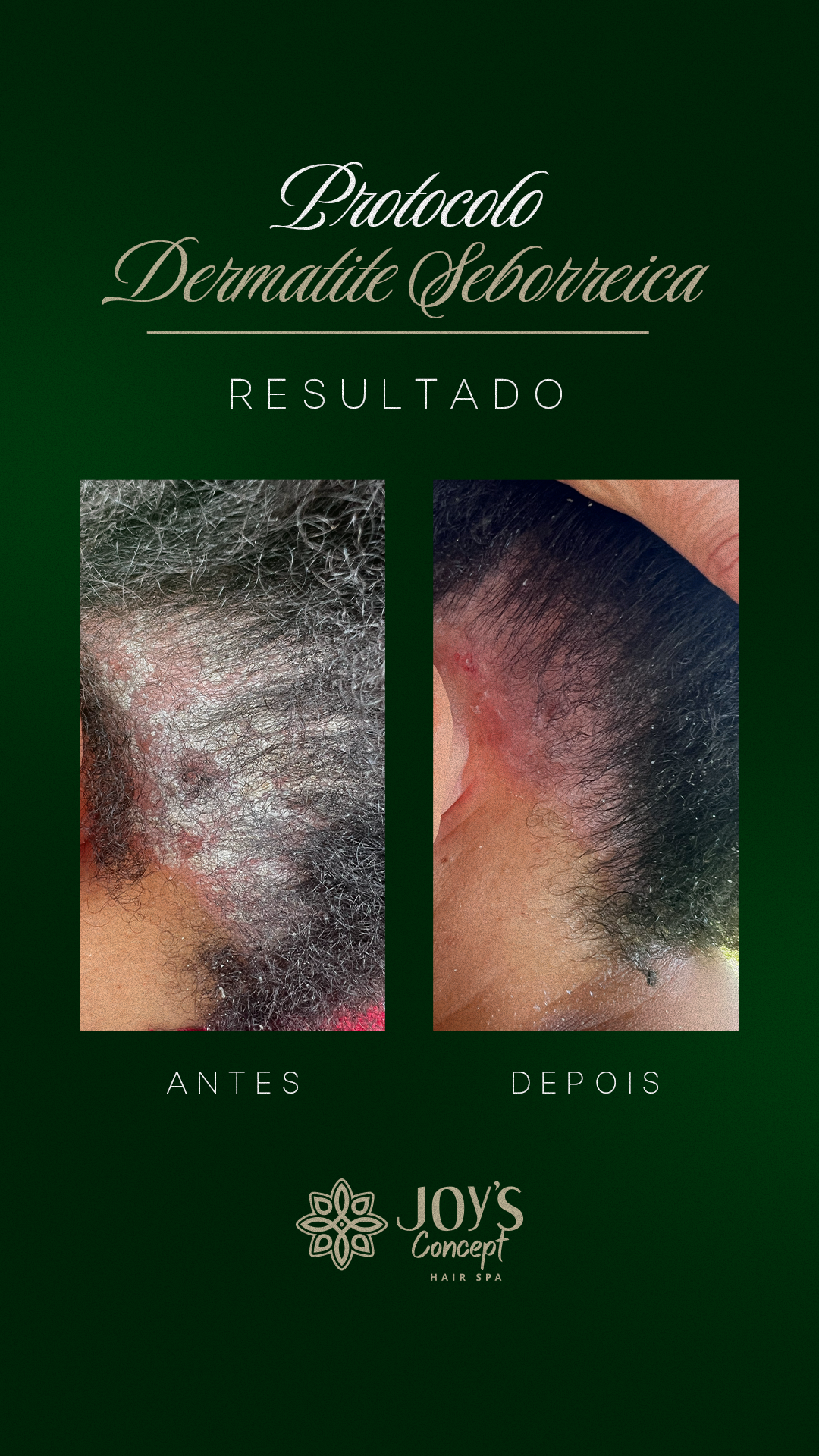 0402---Antes-X-Depois15.2---Dermatite-Seborreica