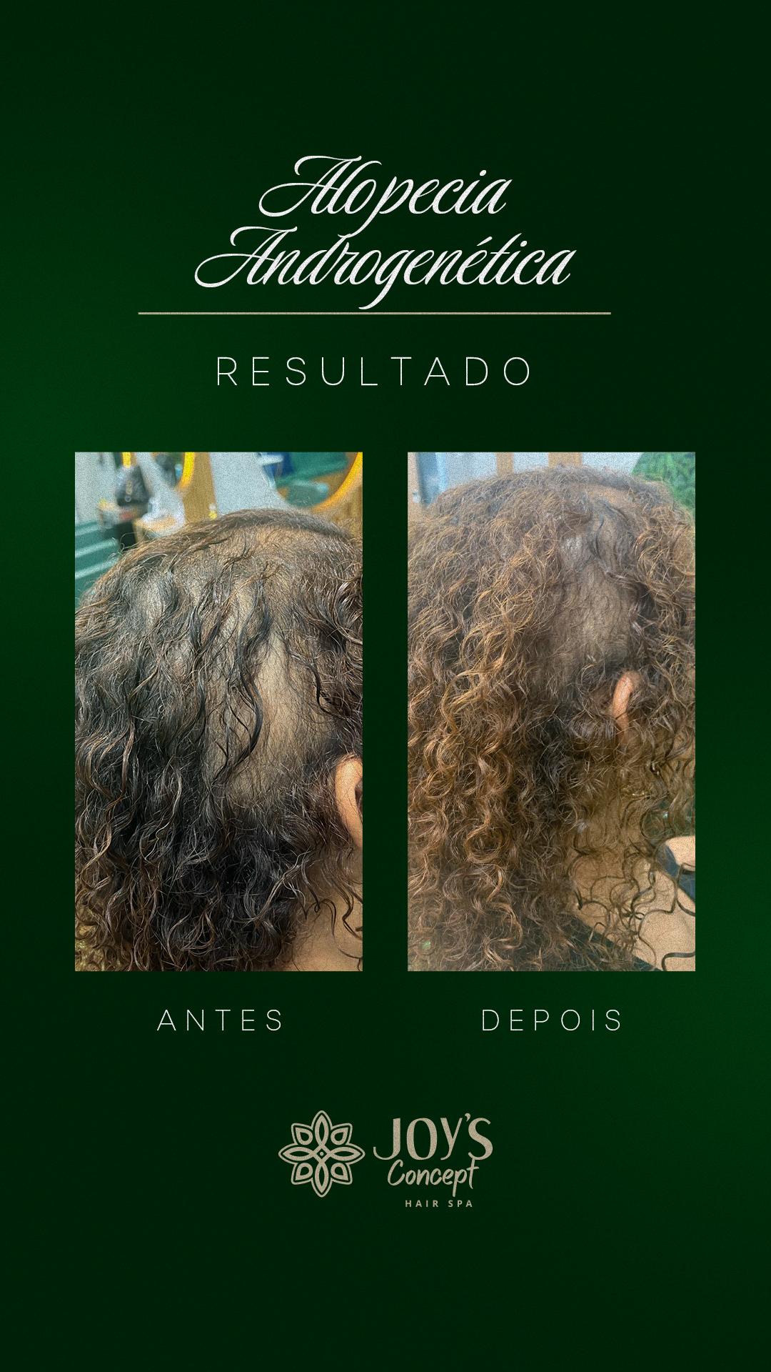 0402---Antes-X-Depois16-Alopecia-Androgen_C3_A9tica