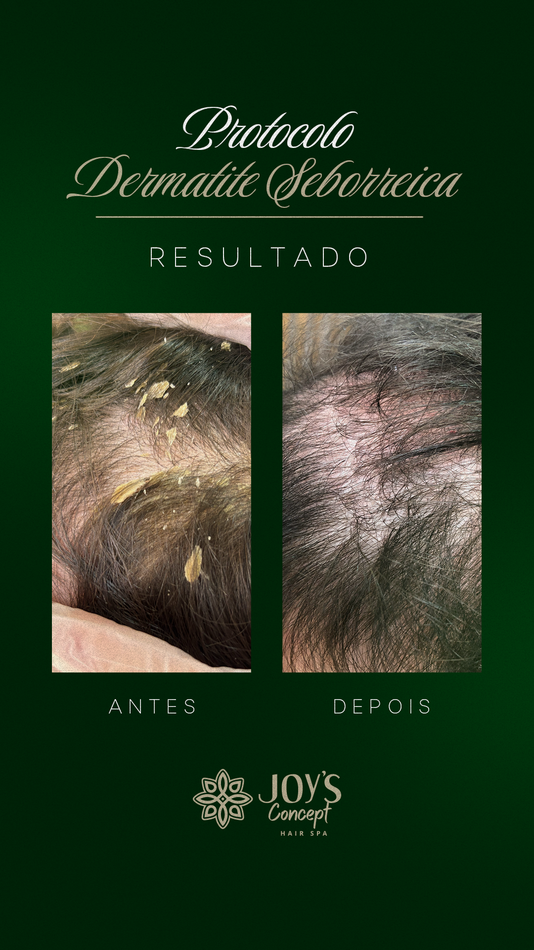 0402---Antes-X-Depois17---Dermatite-Seborreica
